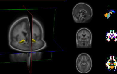 Brain imaging
