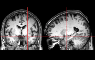 Amygdala / autism study
