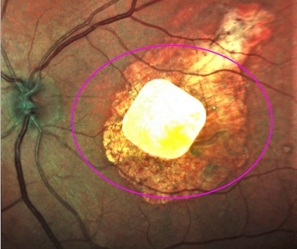 Implanted chip in eye for macular degeneration
