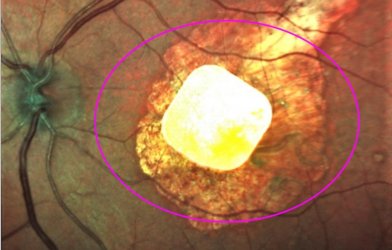 Implanted chip in eye for macular degeneration