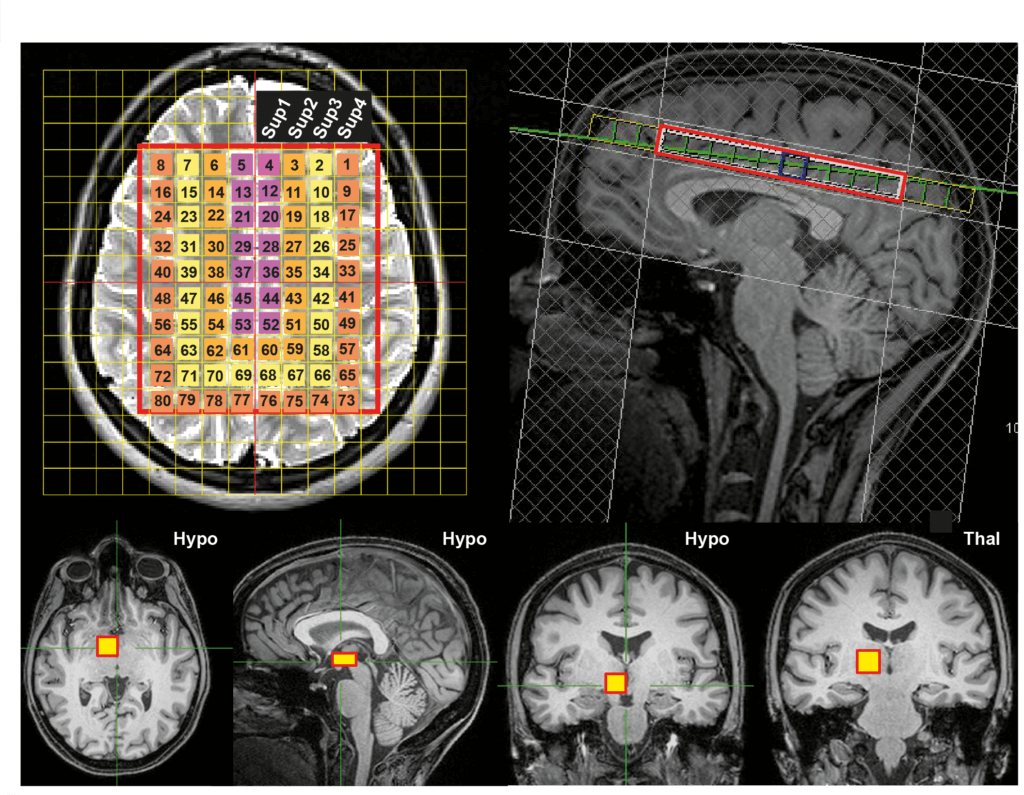 Non-invasive brain thermometry