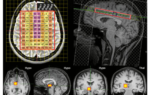 Non-invasive brain thermometry