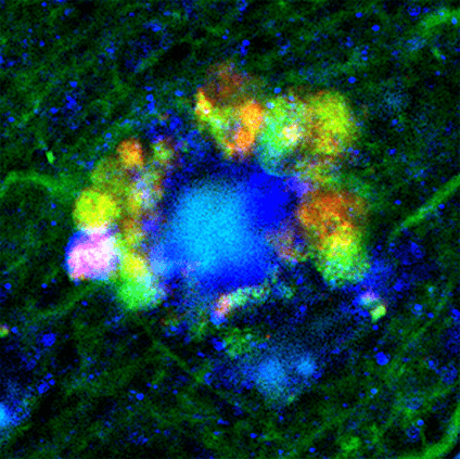 Autophagic vacuoles in neurons of Alzheimer’s disease mouse.