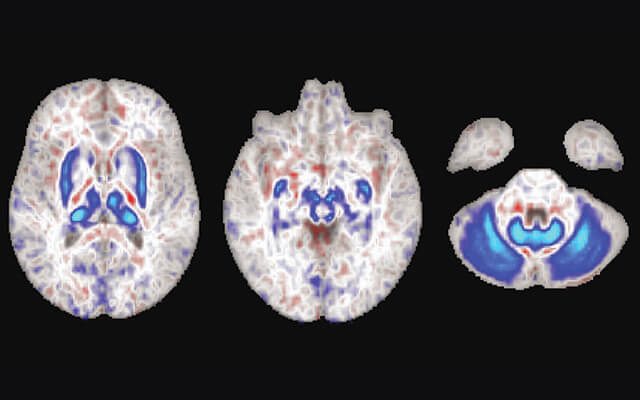 Brain scans reveal iron buildup