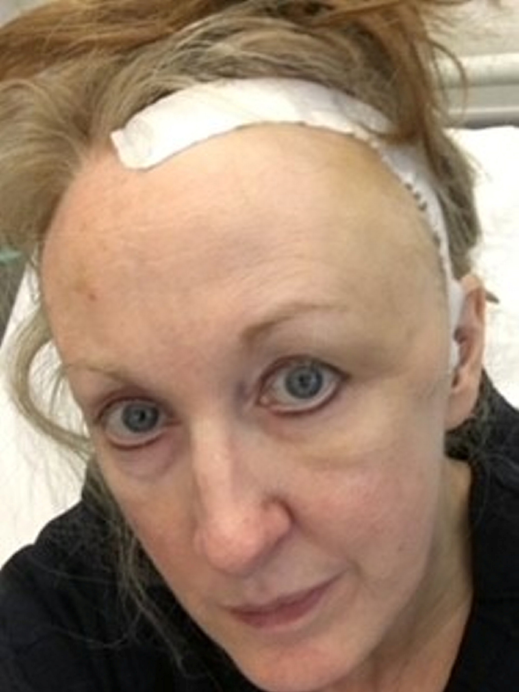 Pictured Alison Wheatley with bandage on scar.