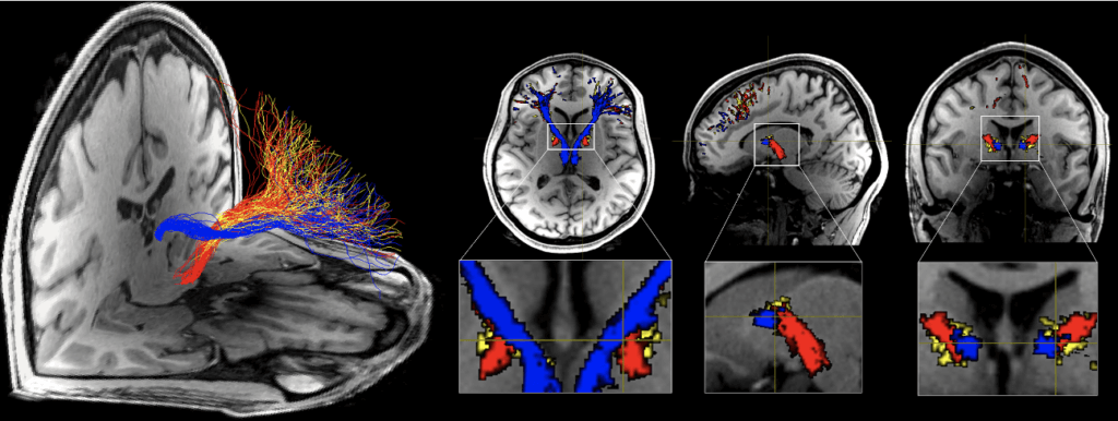 Structural connections with the prefrontal cortex modeled from targeted nuclei in the subcortex